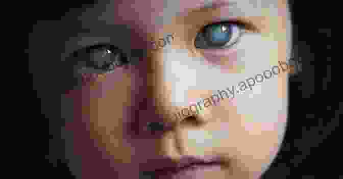 A Child With Glaucoma Pediatric Ophthalmology (Color Atlas And Synopsis Of Clinical Ophthalmology)