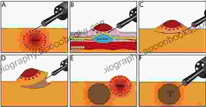 Endoscopic Submucosal Dissection Colorectal Lesions Endoscopic Submucosal Dissection An Issue Of Gastrointestinal Endoscopy Clinics (The Clinics: Internal Medicine 24)