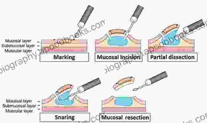 Endoscopic Submucosal Dissection Early Gastrointestinal Malignancies Endoscopic Submucosal Dissection An Issue Of Gastrointestinal Endoscopy Clinics (The Clinics: Internal Medicine 24)