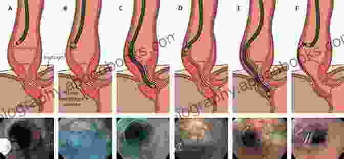 Endoscopic Submucosal Dissection Esophageal Lesions Endoscopic Submucosal Dissection An Issue Of Gastrointestinal Endoscopy Clinics (The Clinics: Internal Medicine 24)