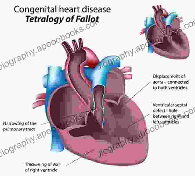 Heart Failure In Adult Congenital Heart Disease Heart Failure In Adult Congenital Heart Disease (Congenital Heart Disease In Adolescents And Adults)