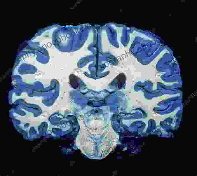 Image Of Gray Matter In The Brain, Highlighting Its Intricate Structure And Connections. The Teen Brain (Gray Matter)